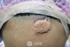 激光祛疤真实果图片差别太大，惊艳了所有人