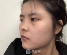 微晶瓷隆鼻价格真的不贵!这下算是给鼻影说bye bye咯!