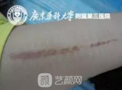 像素激光祛疤果觉得不好？那你可能做了一个假的像素激光