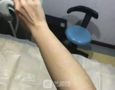 在昆明附二院做了激光脱毛以后，感觉自己终于不怕被发现体毛了
