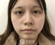 妹子改脸型案例分享｜精致小V脸秘诀~