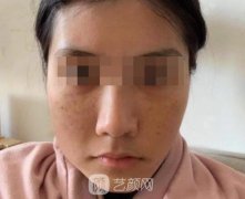 镭射美肤怎么样？看看我的亲身经历吧！