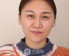 眼角除皱术淡化眼部皱纹尽显年轻姿态，让我以后可以放心大胆肆意笑