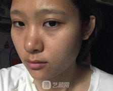 激光全身美白改良黄黑皮，恢复之后朋友羡慕得很