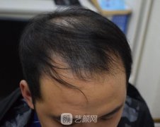 秃发移植让我摆脱油腻大叔成为一枚小鲜肉啦！