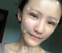 预约了新乡芳艺整形的全切双眼皮，超自然的形态我很喜欢!