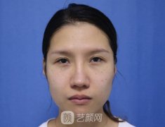 玻尿酸填充泪沟真的让我年轻了几岁呢，也变漂亮了很多