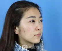 之心激光祛斑果超干净｜让女孩子都可以变成小白脸