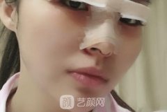 埋线双眼皮和隆鼻美丽套餐，丑丑的蚕蛹化身为漂亮蝴蝶!