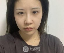 只是做了一个眼部微整形｜就感觉迎来了自己的颜值高级