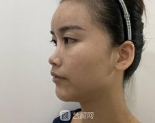 硅胶垫鼻子难怪辣么多人喜欢，跟风做一个很自然叻!