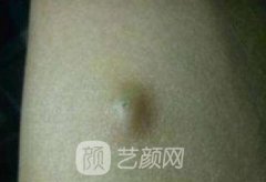 武汉大学中南医院整形美容科价格表收费详细，还有祛脂肪瘤经历日记
