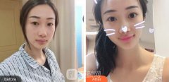 廊坊市人民医院整形外科价格表，附玻尿酸隆下巴经验分享