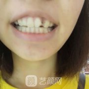 山东大学齐鲁医院口腔科怎么样?价格表和做种植牙前后经历分享
