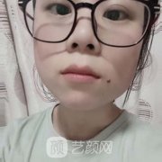 广东省第二人民医院整形科价格表费用和点痣果展示