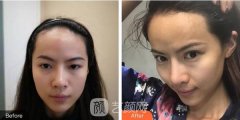上海东方医院整形科价格表新版及纹发际线果发布