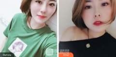 北医三院整形外科价格表2020新版曝光，附狐臭案例