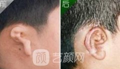 西京医院整形科价格表(价目表)2020，附耳部整形案例实图