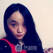 佛山市一整形美容科激光祛斑案例一览