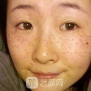 广西人民医院整形激光整形中心激光祛斑全过程分享