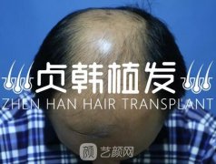 贞韩植发案例|他遭遇大面积植发难题这样破解~