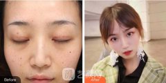 农村的我做了三次彩光复合嫩肤面部皮肤得到了很大改良