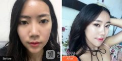 上海华美隆鼻+填泪沟照，父母都称赞我又小了十岁！