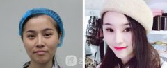 北京301医院脂肪填充术后果图