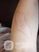 像素激光祛疤果觉得不好?那你可能做了一个假的像素激光