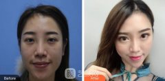 激光祛红血丝靠谱不?总结一下我做激光祛红血丝的心路历程吧!