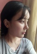 靳小雷做下颌角费用高吗？果怎么样？