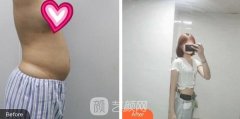 重庆珂琳雅吸脂瘦腰亲身经历的日记分享给你们