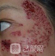 上海中山医院整形科去胎记案例分享