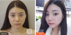 南京美贝尔抽脂瘦案例前后果图