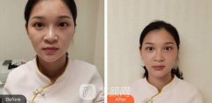 西安爱特蜜医疗美容激光美肤祛斑果分享~
