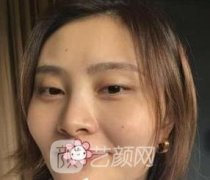 张笑天下颌骨截骨真实感受案例