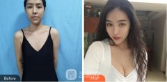 现在同济医院自体脂肪隆胸案例一览~