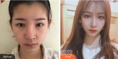 石化建国医院隆鼻价格表|术后案例经历分享
