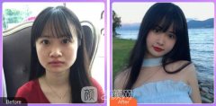 天津医科大学总医院整形科注射瘦脸案例分享~