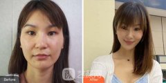 邯郸华美医院做眼部手术多少钱？