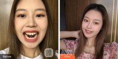 邳县四院整牙价格一览表，牙齿矫正果咋样？