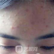 为什么常有人说像素激光去痘果不明X？真实原因在这