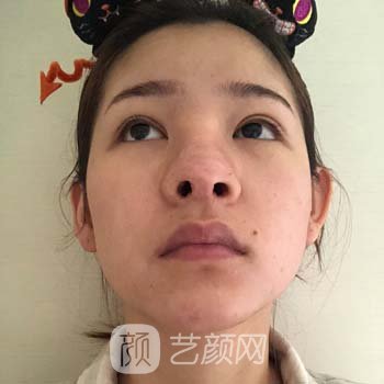上海美萊整形醫院做鼻子案例
