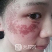 西南医院整形外科祛疤案例