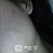 四川大学华西第二医院整形科激光去胎记案例