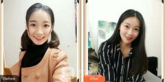 南昌大学第二附属医院整牙案例分享~