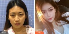 北大医院整形科隆鼻案例果