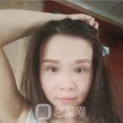 北京八大处下颌角填充案例果图