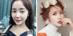 北京同仁医院整形科双眼皮果好不好