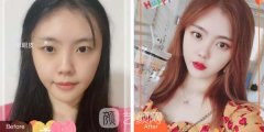 浙江邵逸夫医院整形科割双眼皮案例